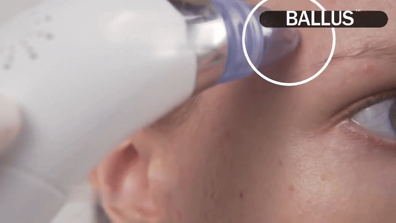 ๐โโ๏ธPore Cleaning Device | Blackhead Remover Vacuum USB Rechargeable